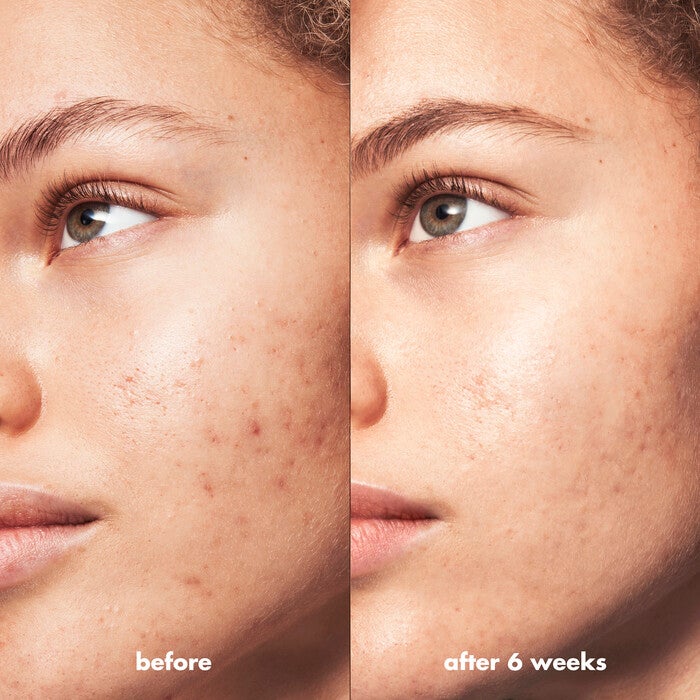 Blemish Breakthrough Triple-Acid Resurfacing Serum Mini, 